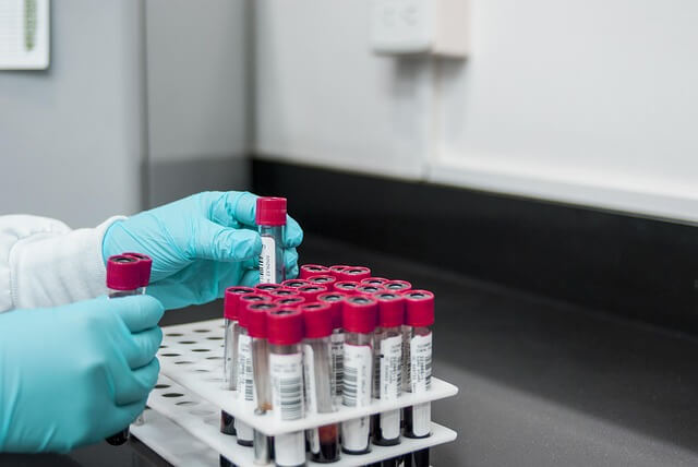 Blood samples in a lab being looked at by a person 